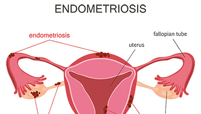 What to know about endometriosis and infertility