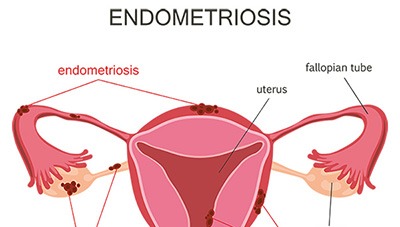 Τι πρέπει να γνωρίζετε για την ενδομητρίωση και τη γονιμότητα